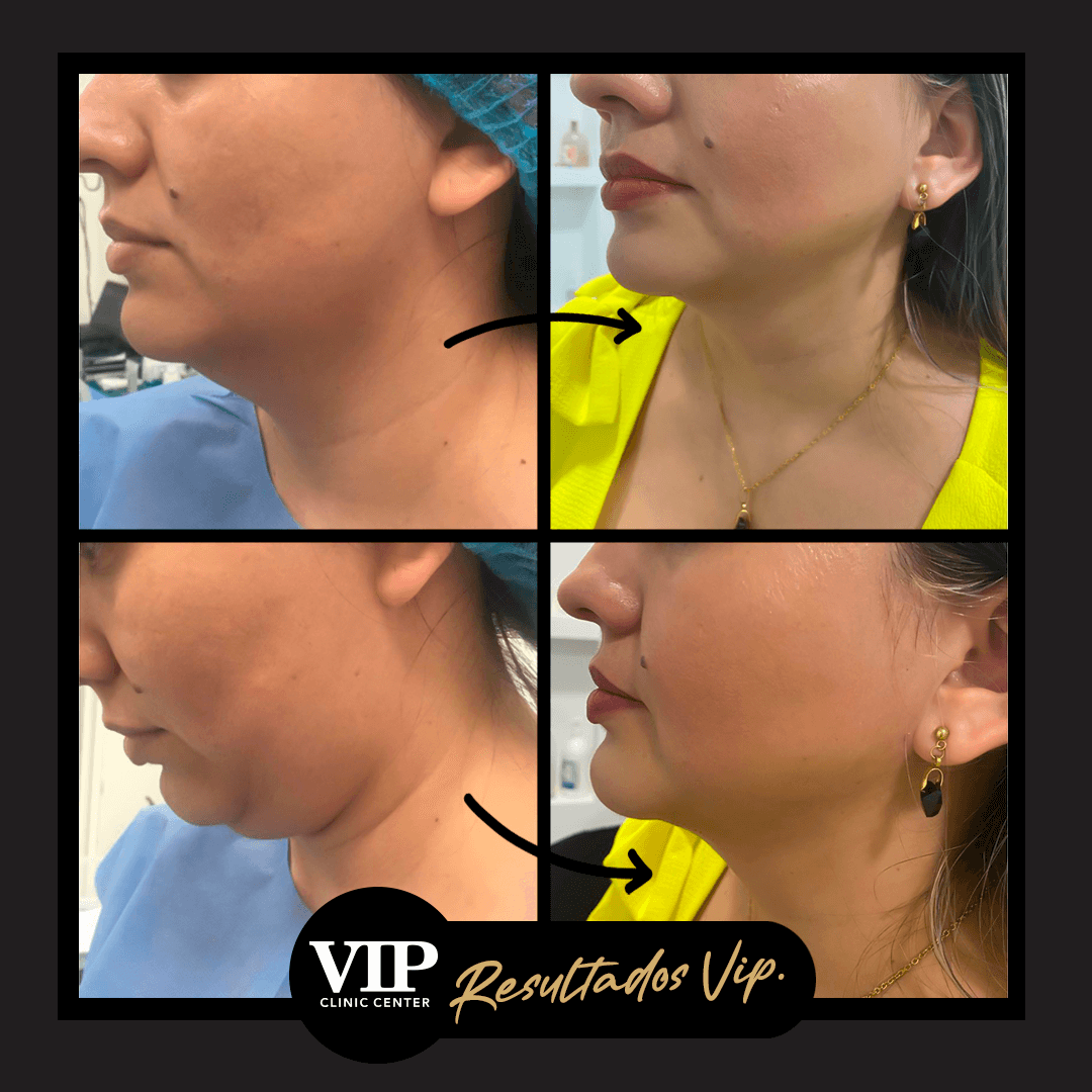 Facial